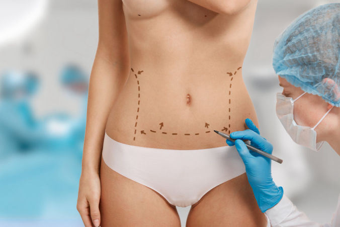 Foto Abdominoplastia